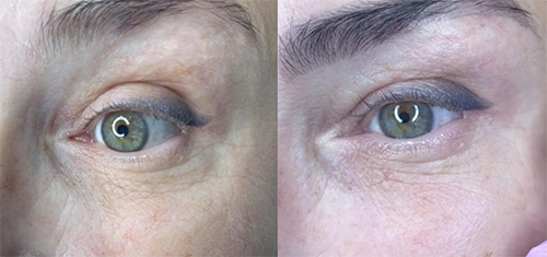 mesoten-eyes